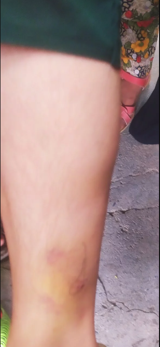 Shabnam, one of the victims of police brutality, shows her bruised leg.Kashmir