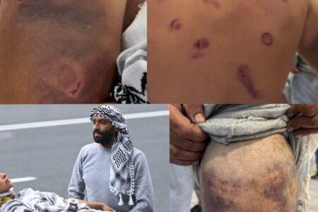 Flotilla activists' abuse and torture (1) Bruises on the backs and limbs of Global Sumud Flotilla activists